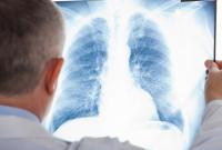 Украина оказалась в топ-5 антирейтинга по туберкулезу