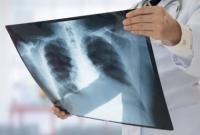 Лікар колишнього тубдиспансеру: ситуація навколо туберкульозу – це середньовіччя номер два
