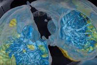 З'явилося відео, як коронавірус вражає легені